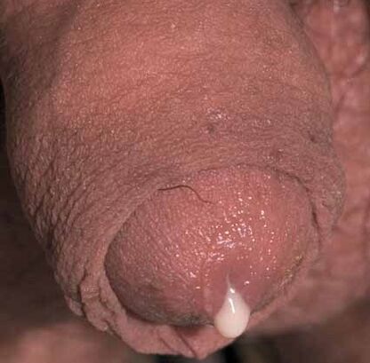 discharge pathology when stimulated